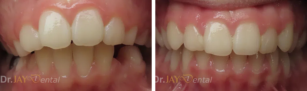 Before and after ceramic implant case