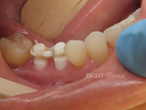 Case 12 before ceramic implant treatment