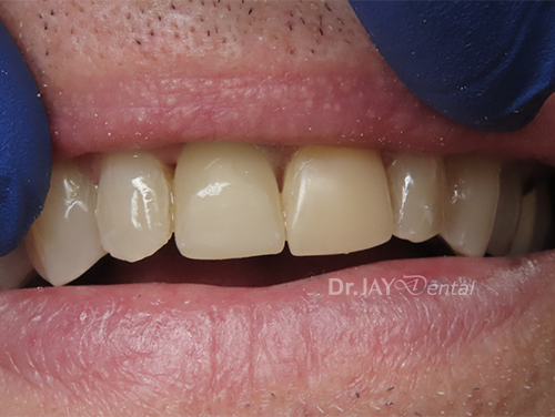 Case 2 after ceramic implant treatment