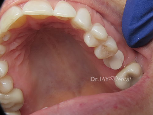 Case 3 before ceramic implant treatment