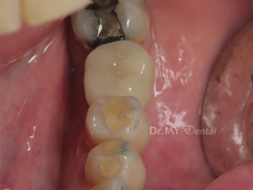 Case 4 after ceramic implant treatment