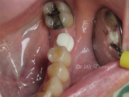 Case 4 before ceramic implant treatment