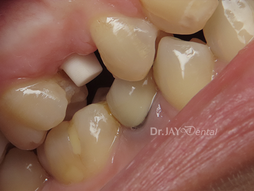 Case 10 before ceramic implant treatment
