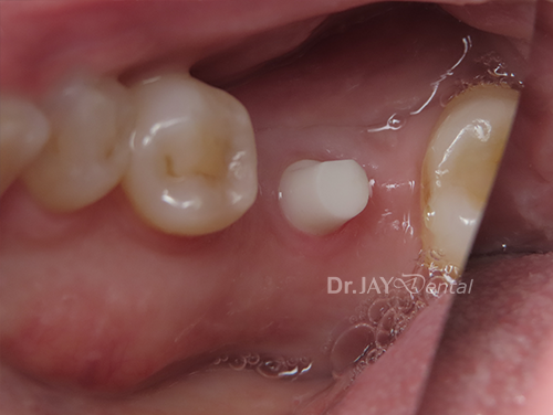 Molar site before ceramic implant treatment