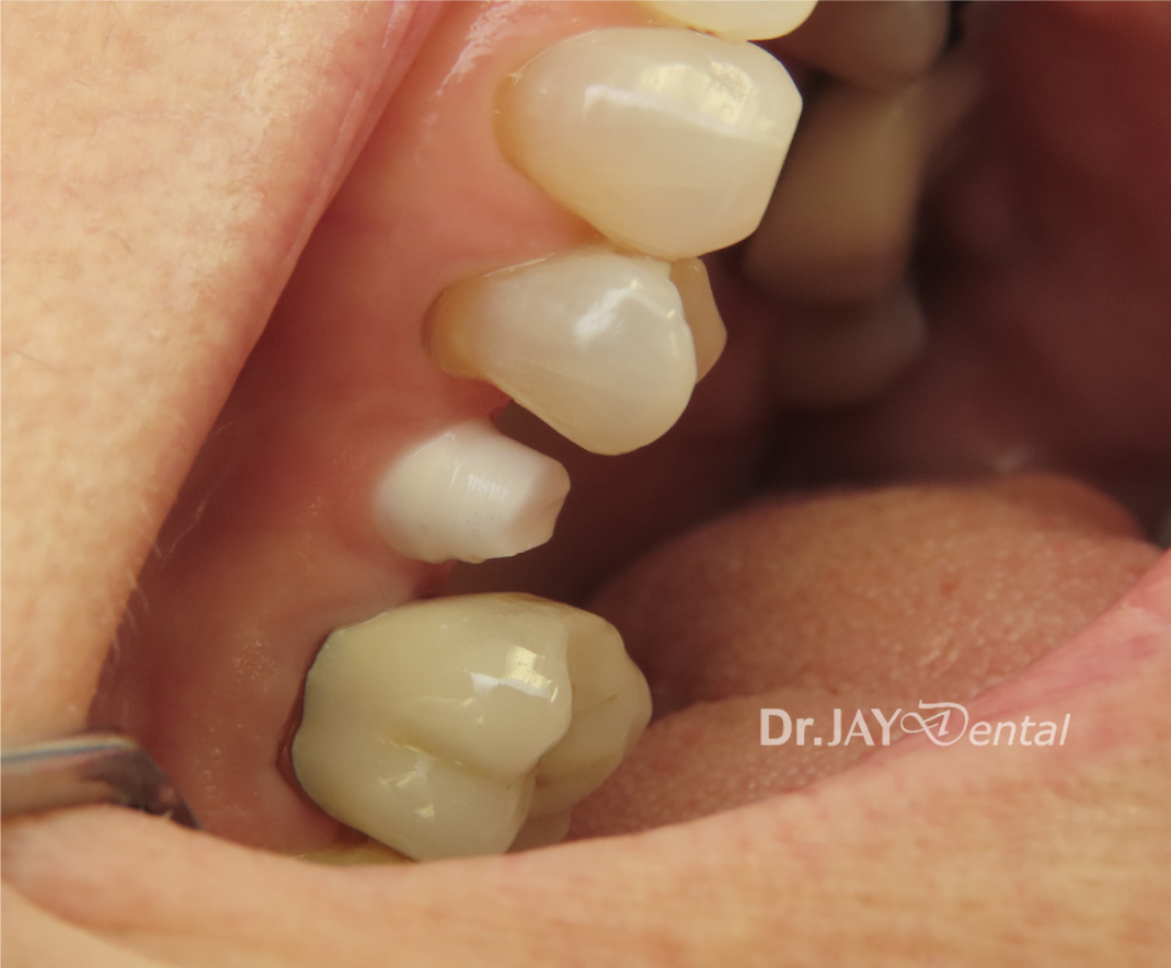 Case 13 before ceramic implant treatment