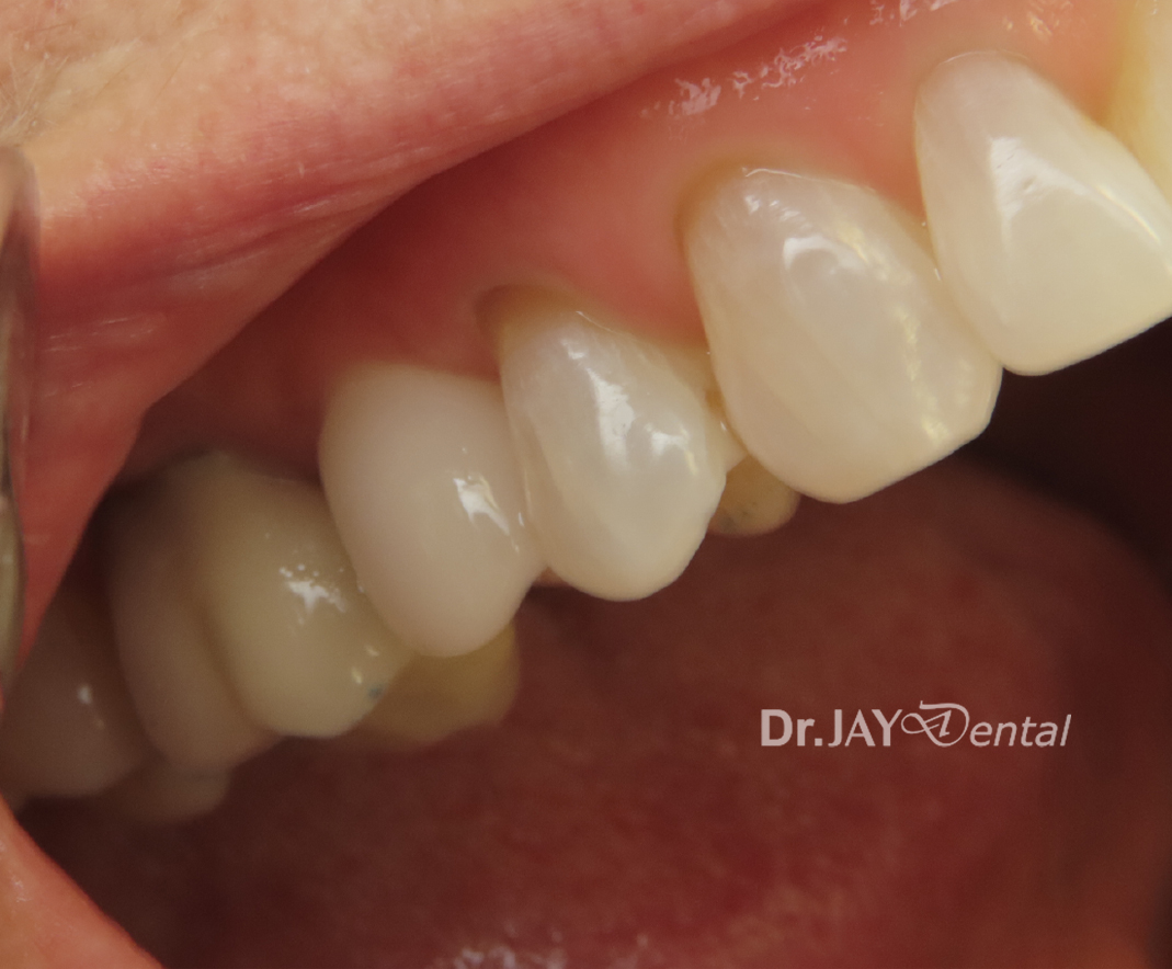 Case 13 after ceramic implant treatment
