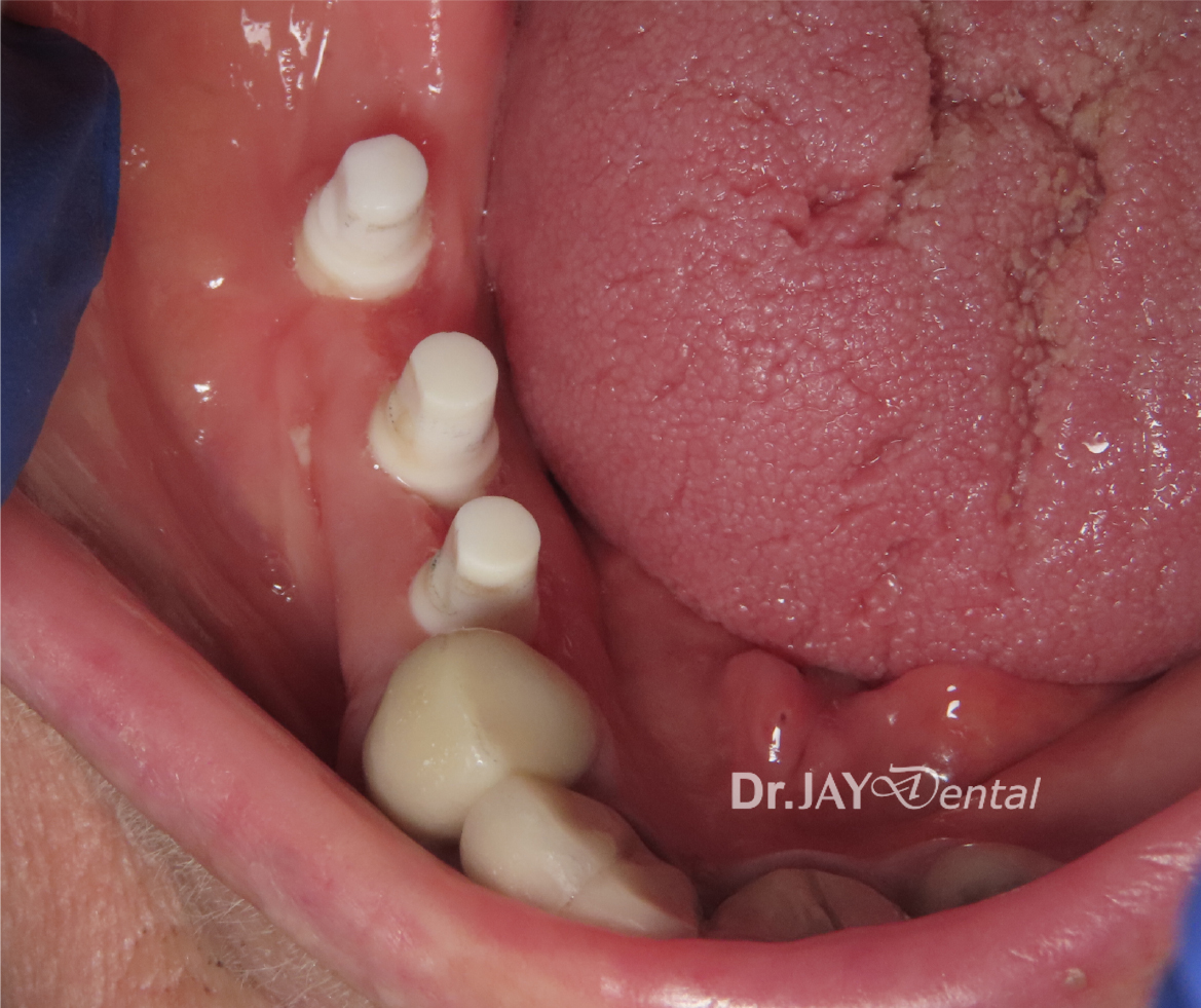 Case 5 ceramic implant treatment