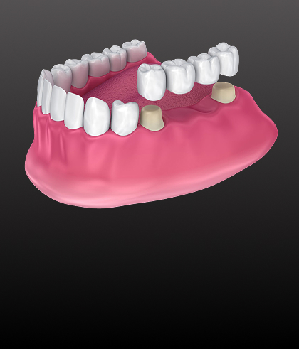 Digitally planned dental restoration